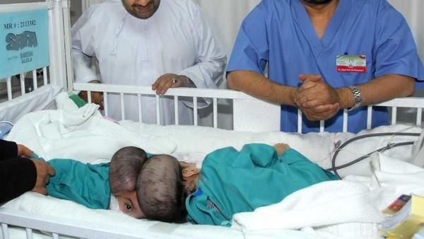 السعودية | صور لتوأم عماني أمر الملك عبدالله بإنقاذهما قبل 11 عاما