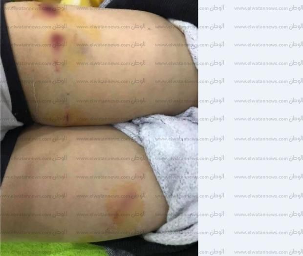بالصور| خالة «طفل مدينتي» تروي تفاصيل واقعة مهاجمته من كلبين «شديدي الشراسة»