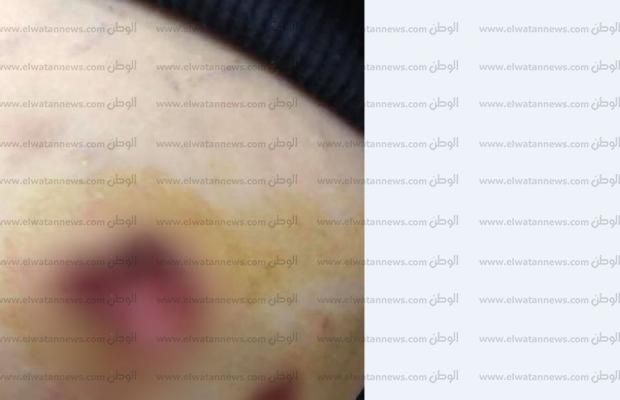بالصور| خالة «طفل مدينتي» تروي تفاصيل واقعة مهاجمته من كلبين «شديدي الشراسة»