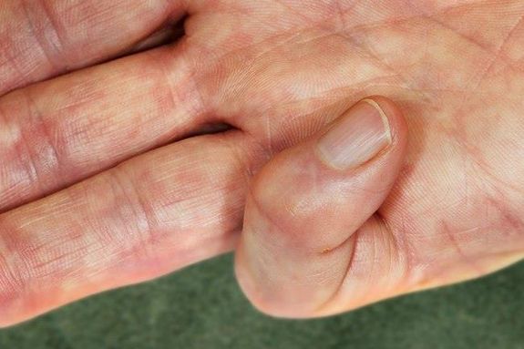 هل تتورم أصابعك؟.. إليك 15 سبباً محتملاً