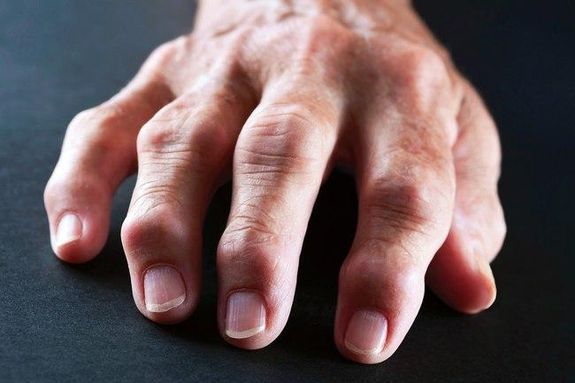 هل تتورم أصابعك؟.. إليك 15 سبباً محتملاً