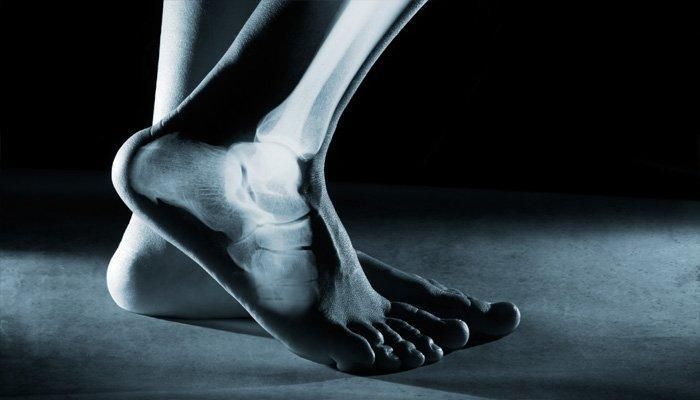 6 نصائح للوقاية من هشاشة العظام بعد سن الـ35