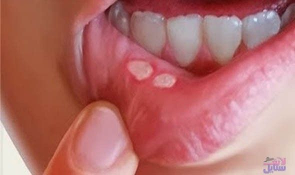 سبب إصابة السيّدات والمراهقات على الأخص بقرح الفم