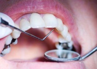 منها زيت جوز الهند..طرق منزلية تساعد في التخلص من تسوس الأسنان