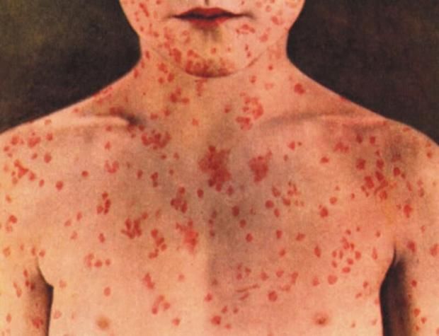 طرق علاج الحصبة الألمانية