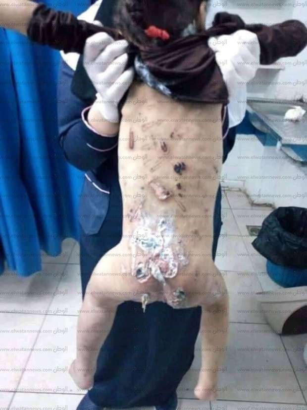 بين حرق الجدة واغتصاب الخال.. التفاصيل الكاملة لتعذيب وبتر قدم الطفلة جنة