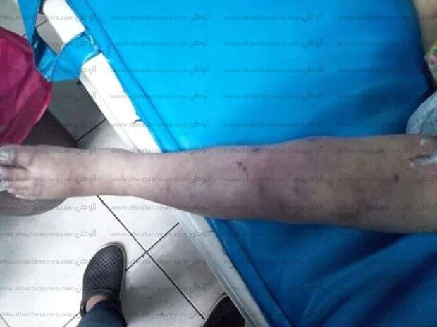بين حرق الجدة واغتصاب الخال.. التفاصيل الكاملة لتعذيب وبتر قدم الطفلة جنة