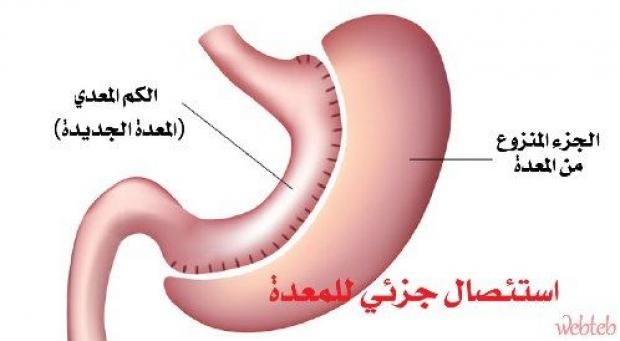 أعراض وأسباب سرطان المعدة وطرق الوقاية