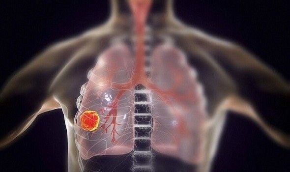 الكشف عن أعراض وعلامات في العين تشير إلى احتمال الإصابة بالسرطان