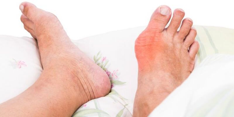 س وج.. ماهو مرض النقرس وما أسباب الإصابة به؟