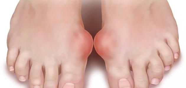 س وج.. ماهو مرض النقرس وما أسباب الإصابة به؟
