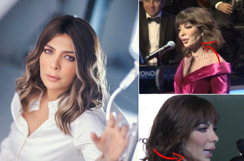 نتوءات غريبة ظهرت على وجه أصالة في حفل الكويت.. والجمهور يتساءل