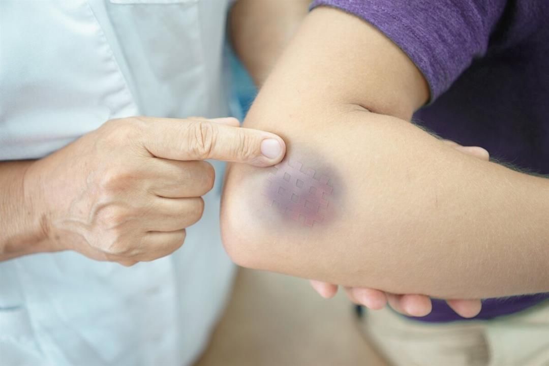 قد تظهر دون سبب.. ما الذي يسبب الكدمات؟