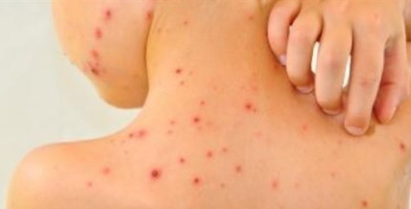 اذهبي للطبيب فورا.. كيف تكتشفين إصابة ابنك بالجدري المائي؟