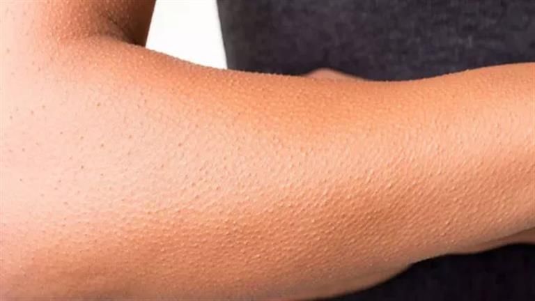 علامات تظهر على الجلد تكشف نقص 6 فيتامينات بجسمك