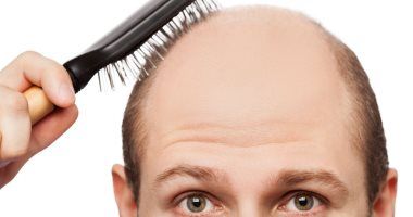 الثعلبة والصلع.. أهم الأعراض المرضية لارتفاع هرمون الذكورة عند الرجل