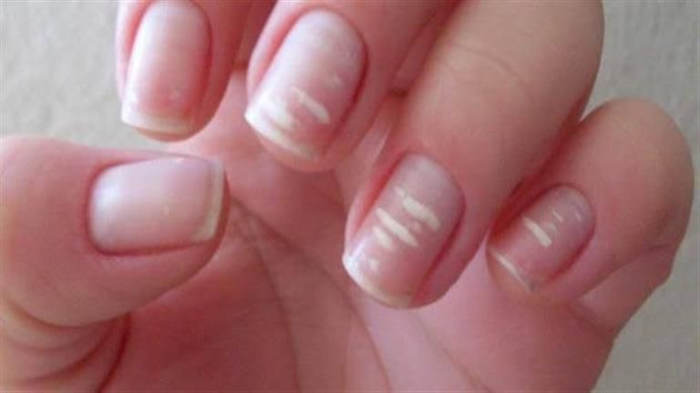علامات في الأظافر تنذر بمشكلات صحية خطيرة.. «خلي بالك من لونها»