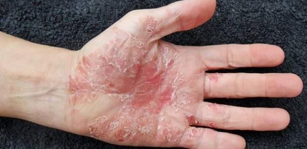 علاج للصدفية بـ 50 جنيها.. تخلص من المرض المزمن بمكون طبيعي