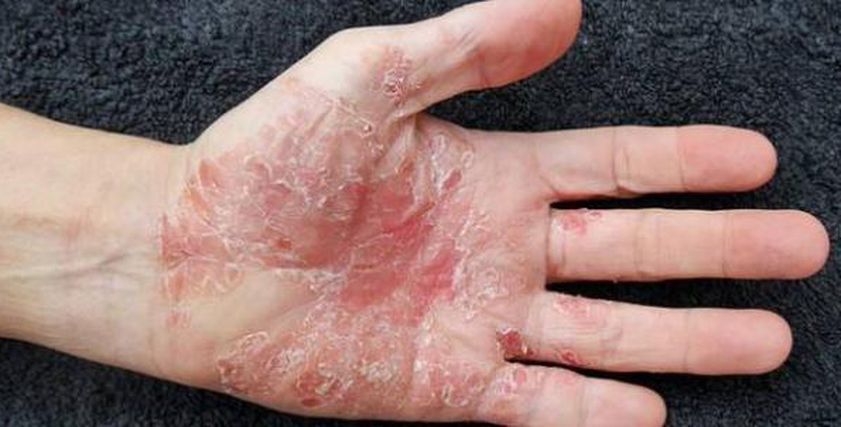 علاج للصدفية بـ 50 جنيها.. تخلص من المرض المزمن بمكون طبيعي