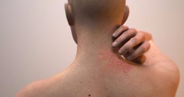 تعرف على عدوى السعفة الجلدية.. أكلات تساعد على علاجها