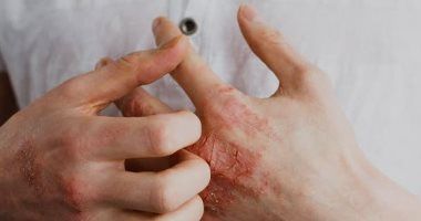 من التدفئة الزائدة إلى ملابس الصوف.. 5 أخطاء تدمر بشرتك فى الشتاء