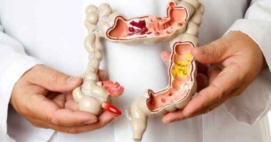 متى يجب استئصال جزء من القولون؟.. استشارى يوضح الأسباب