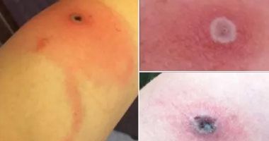 ما لا تعرفه عن جدري ألاسكا الذى قتل أمريكيا نتيجة عدوى من "قطة"