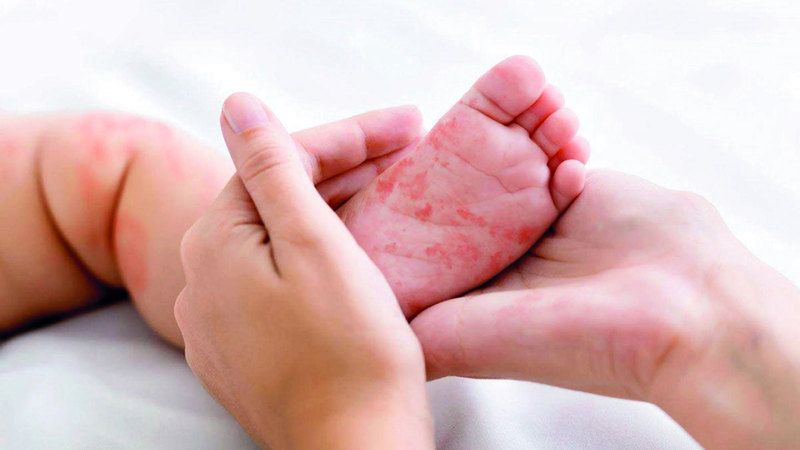 الامارات | مرض «ريكلينغهاوزن».. يحدث بسبب طفرة في الجين