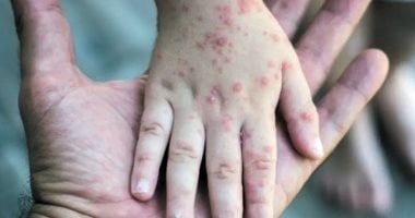 هل يتسبب تفشى جدرى القرود فى إغلاق كامل على غرار كورونا؟ تقرير يوضح