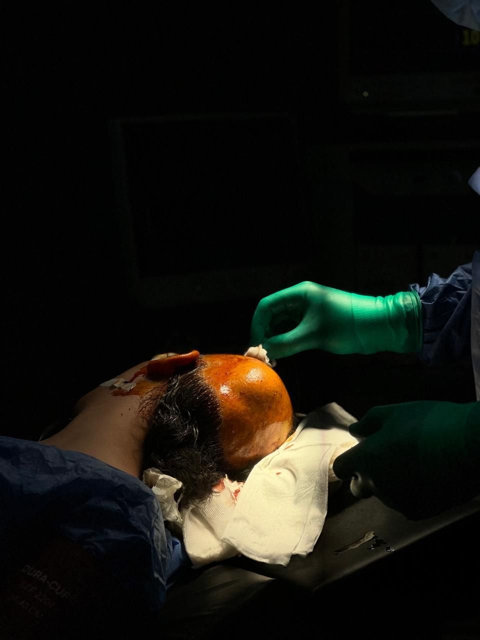 الصحة: جراحة متطورة تعيد الشكل الطبيعي لجمجمة فتاة باستخدام تقنية الطباعة ثلاثية الأبعاد