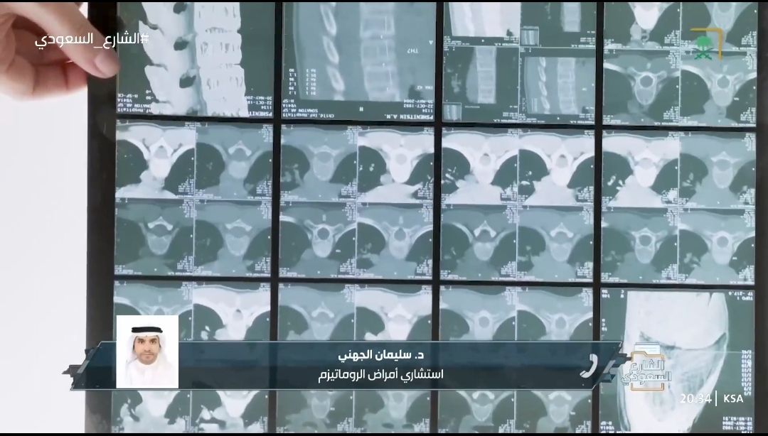 استشاري في أمراض الروماتيزم: هشاشة العظام المرض الصامت.. وعادة لا يتم تشخصيه إلا بعد حدوث كسور