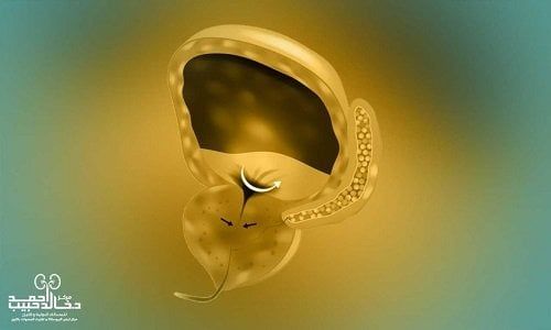 علاج فعال لتضخم البروستاتا مع دكتور خالد حبيب: اكتشف الطرق الحديثة!