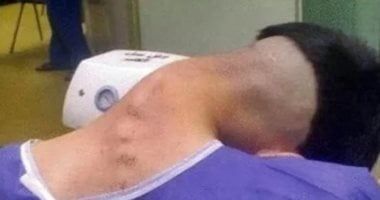 أطباء يوثقون حالة نادرة لمتلازمة الرأس المتدلي ناجمة عن تعاطى المخدرات