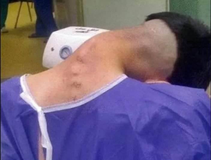 أطباء يوثقون حالة نادرة لمتلازمة الرأس المتدلي ناجمة عن تعاطى المخدرات