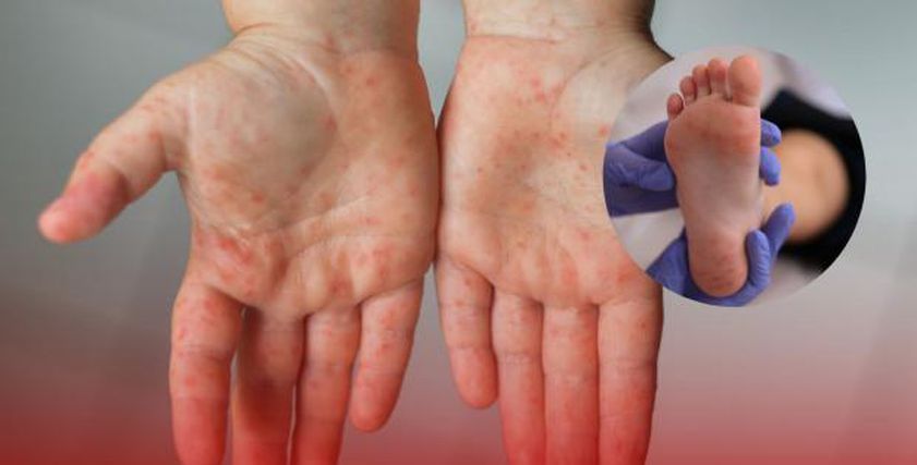 عاجل: عدوى منتشرة تشبه الجدري وترعب الأمهات.. تعرف على فيروس كوكساكي