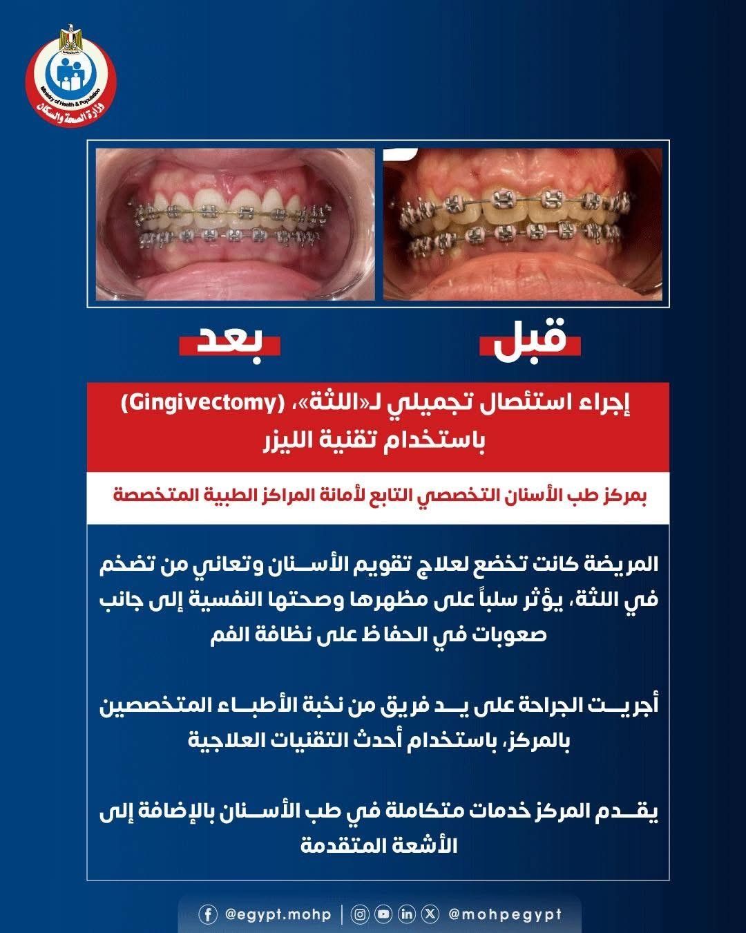وزارة الصحة: إجراء استئصال تجميلى لـ"اللثة" باستخدام تقنية الليزر