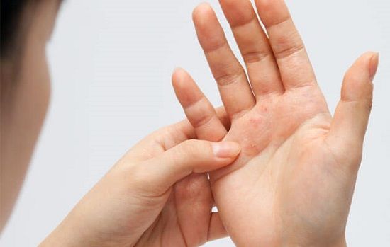 الامارات | ما علاقة الإكزيما بأمراض الكلى المزمنة؟