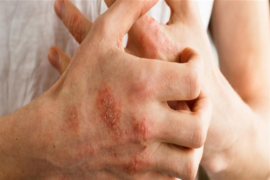 دراسة تكشف العلاقة بين الإكزيما وأمراض الكلى المزمنة
