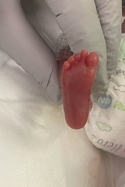 nash-keen-most-premature-baby-closeup-of-foot-after-being-delivered nash-keen-most-premature-baby-closeup-of-foot-after-being-delivered