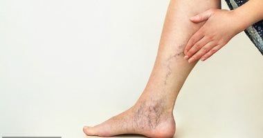 لماذا تظهر الدوالي؟.. تعرف على كيفية علاج هذه الحالة