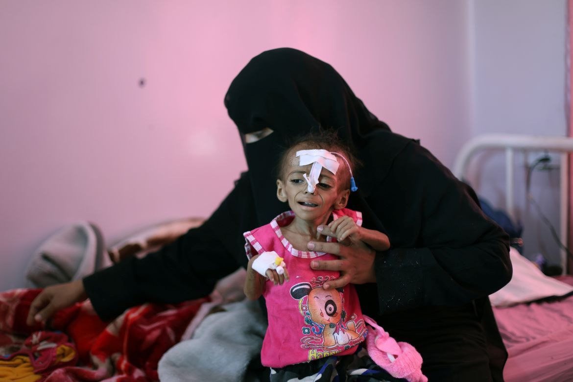 أكثر من 1000 حالة في 6 أشهر.. ارتفاع كارثي لسوء التغذية في عمران يهدد بانهيار صحي.